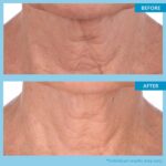 SKINN Neck Cream for Wrinkles, Neck Amour Go away-On Masks - Firming Crea... - Image 8