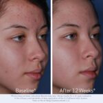 Obagi CLENZIderm M.D. Therapeutic System – 3 Step Pimples Therapy Syste... - Image 4