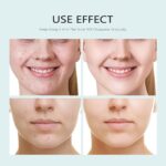 Facial Masks Anti Zits Face Masks Pores and skin Care, Sheet Masks With Salicylic... - Image 3