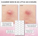 Pimple Patch Extremely-Skinny Invisible Spot Cowl. Quick Performing Hydrocolloid... - Image 8