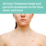 All Pimples Therapy - Face and Physique - Spot and Full Protection - Gel Type... - Image 3