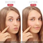 Darkish Spot Remover for Face and Physique - Darkish Spot Corrector Serum for Ac... - Image 5