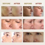 ABERA Melasma Cream (Premium Model) - Darkish Spot Corrector, Melasma, ... - Image 6