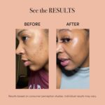 reVive Mild Remedy Lux Assortment Spot Pimples System, Transportable Crimson & B... - Image 4