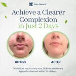 Further Pure Zits Fade Therapy - Most Power Face Cream for Se... - Image 8