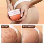 Butt Pimples Clearing Remedy, Physique Cream for Again, Buttocks, Thigh & C... - Image 4